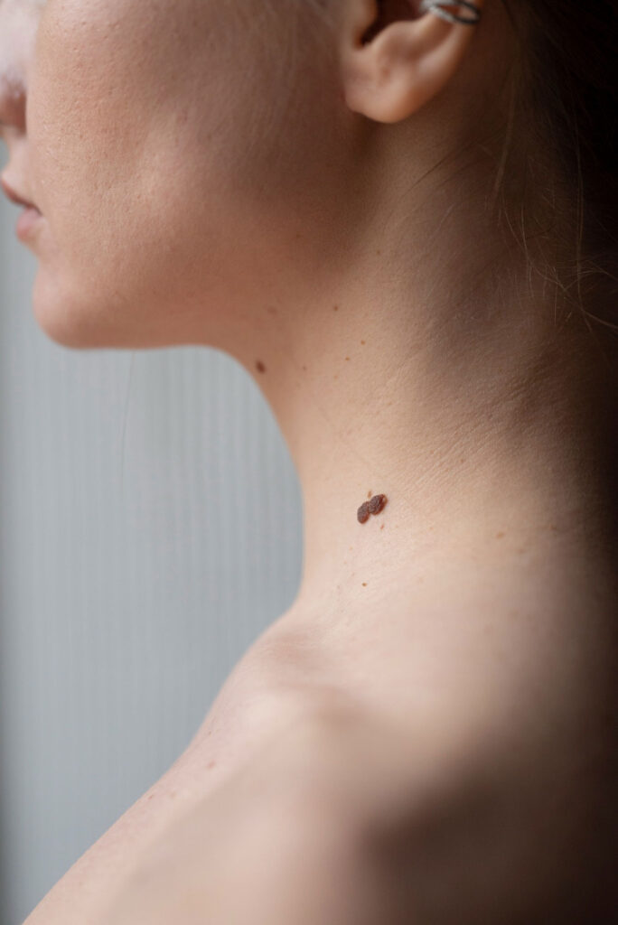 Skin Tag Removal