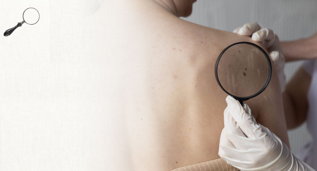 Lesion Removal in Singapore for Skin Tags, Moles, and Lipoma