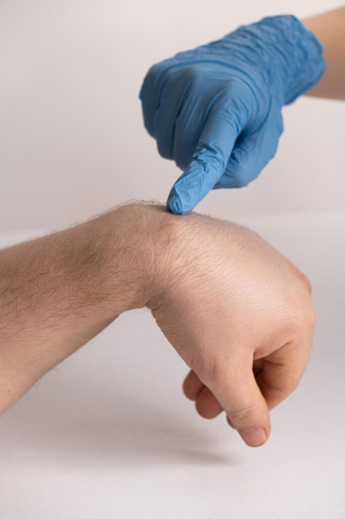 Cyst Removal